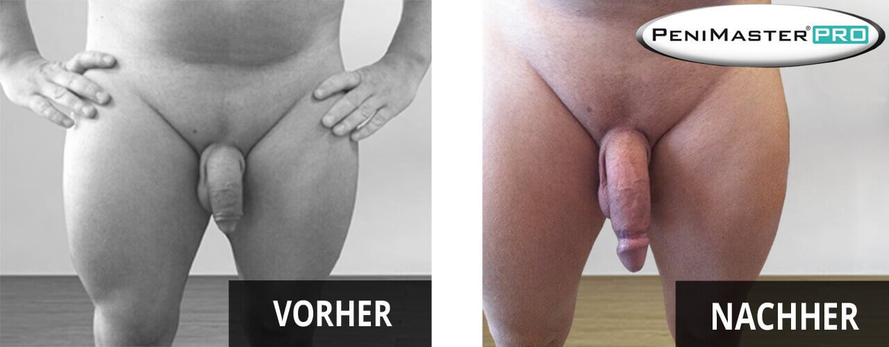 PeniMaster Pro vorher nachher