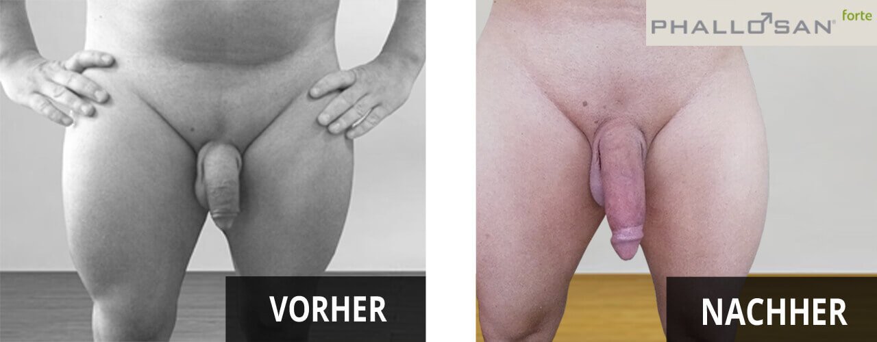Phallosan forte vorher nachher