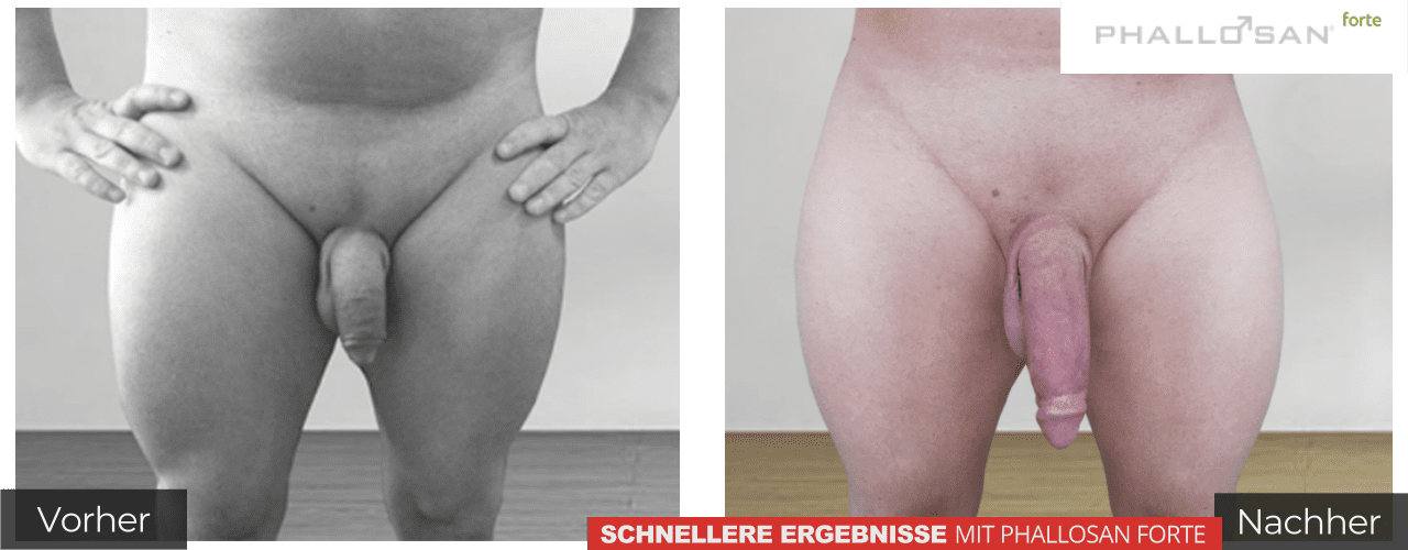 Penis vergrößern mit Phallosan forte